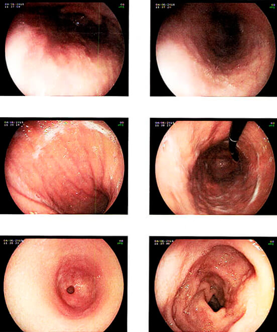 Endoscopia Digestiva Alta